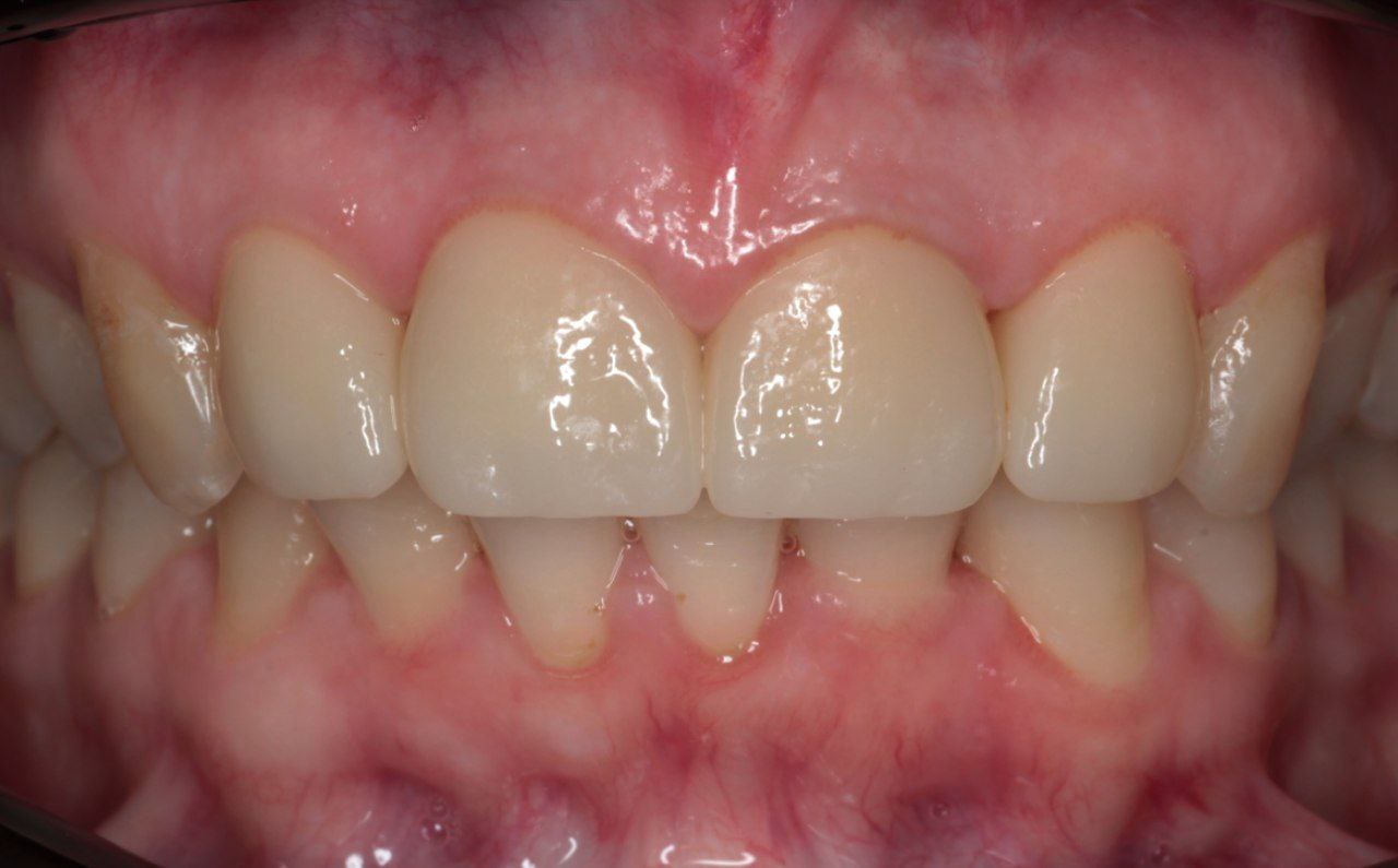 Спасли зуб от удаления! Спасли зуб от удаления!