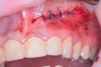 Спасли зуб от удаления! Спасли зуб от удаления!