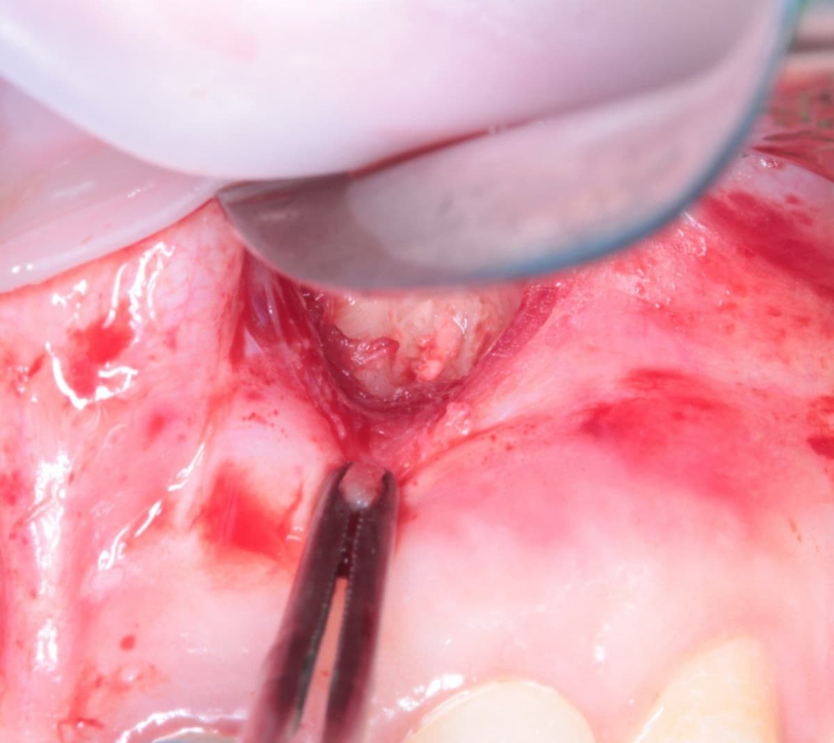 Спасли зуб от удаления! Спасли зуб от удаления!