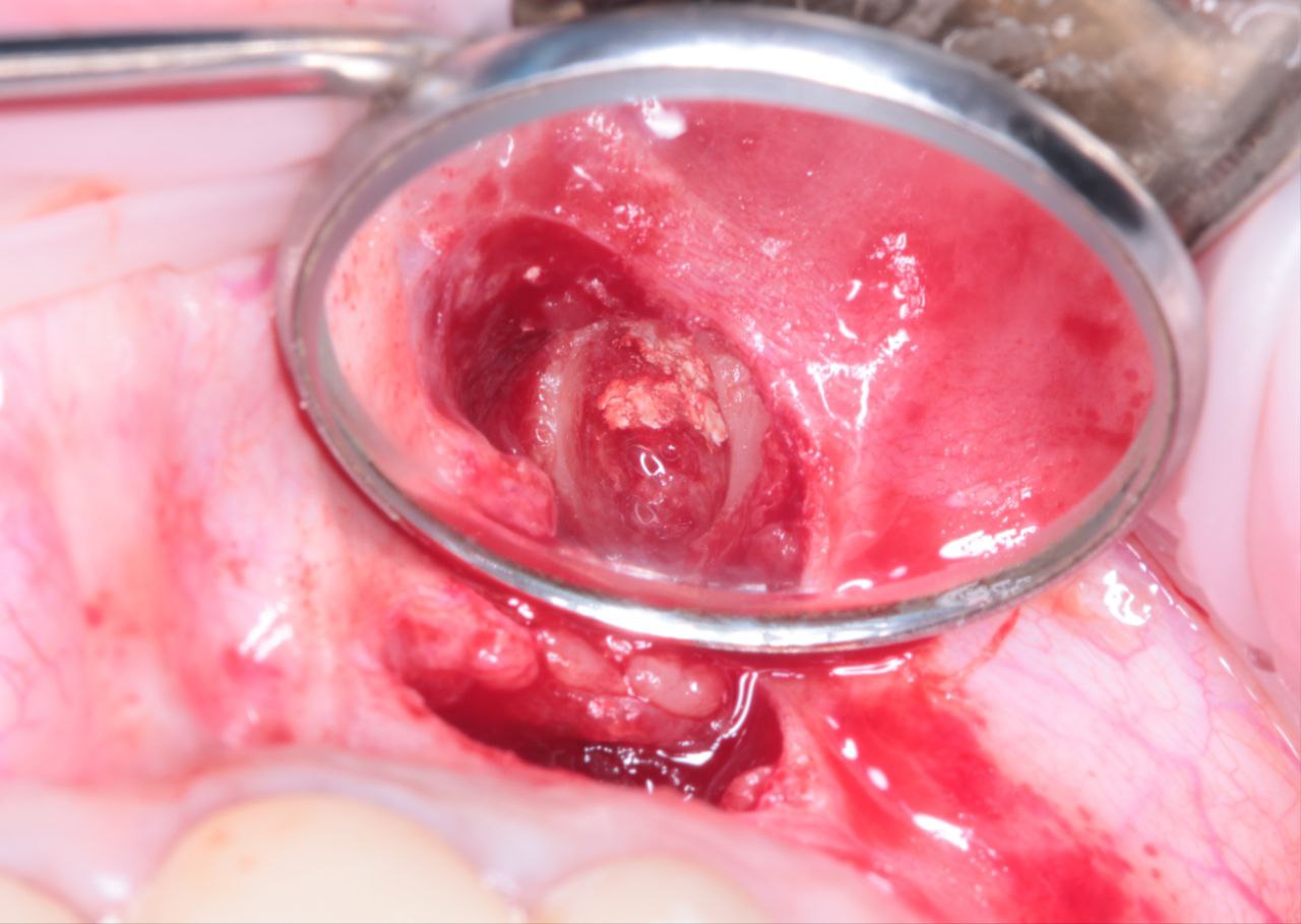 Спасли зуб от удаления! Спасли зуб от удаления!