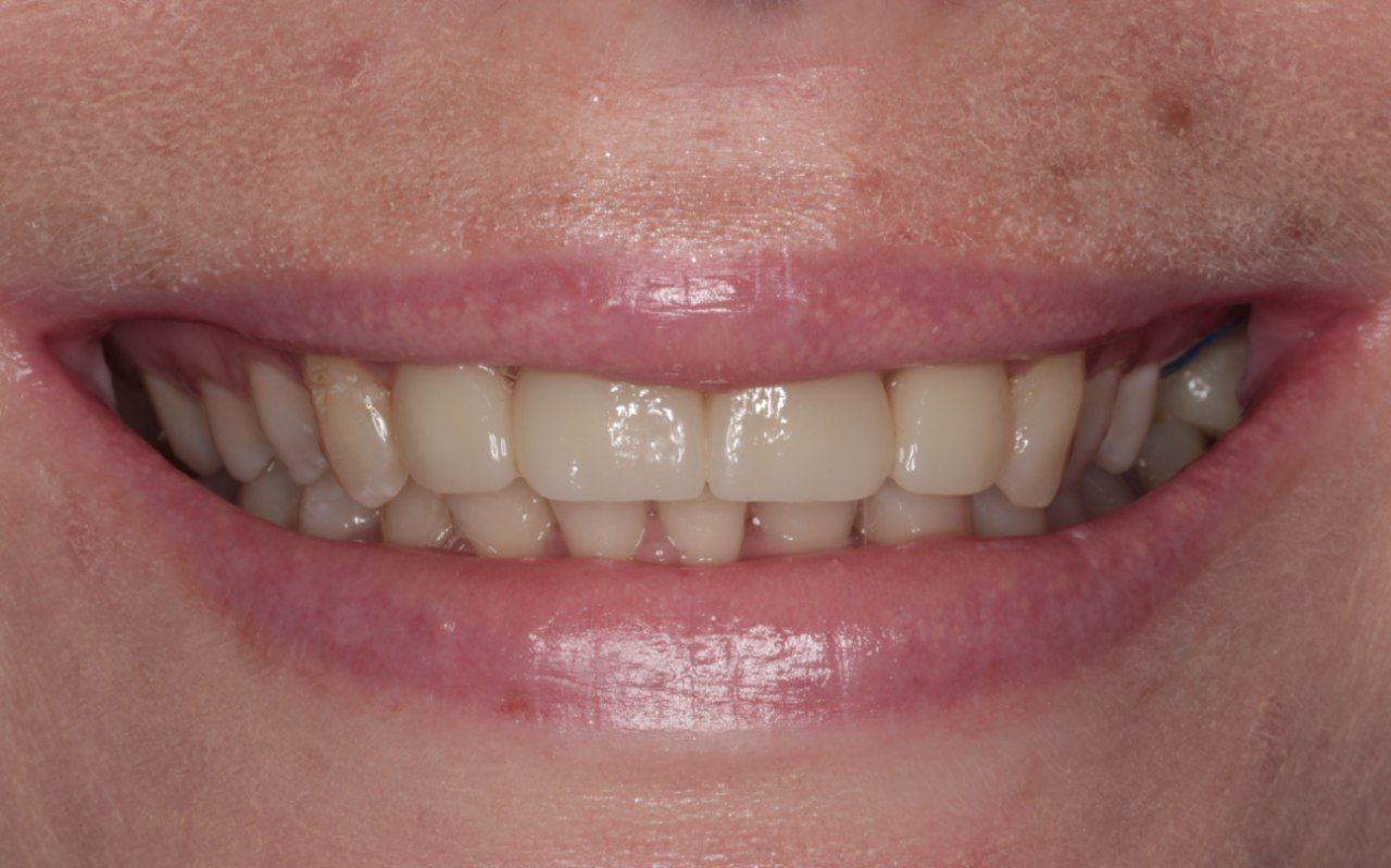 Спасли зуб от удаления! Спасли зуб от удаления!