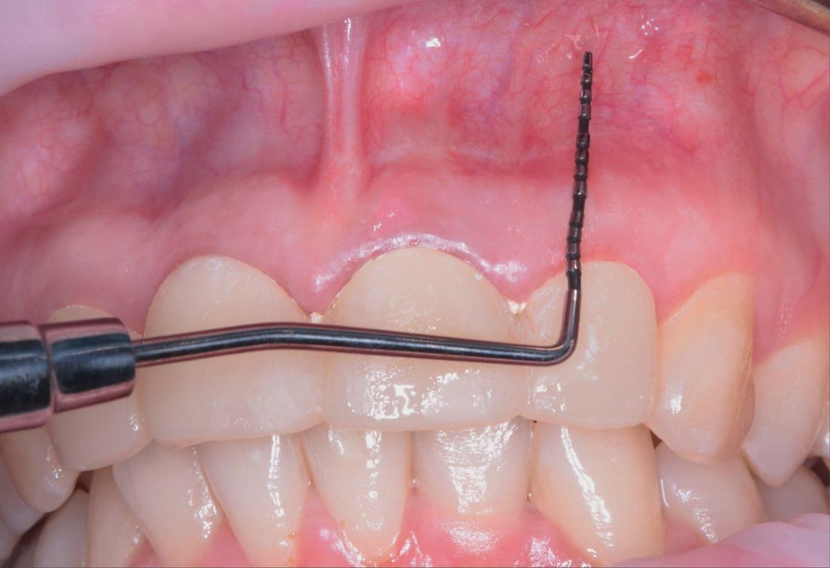 Спасли зуб от удаления! Спасли зуб от удаления!