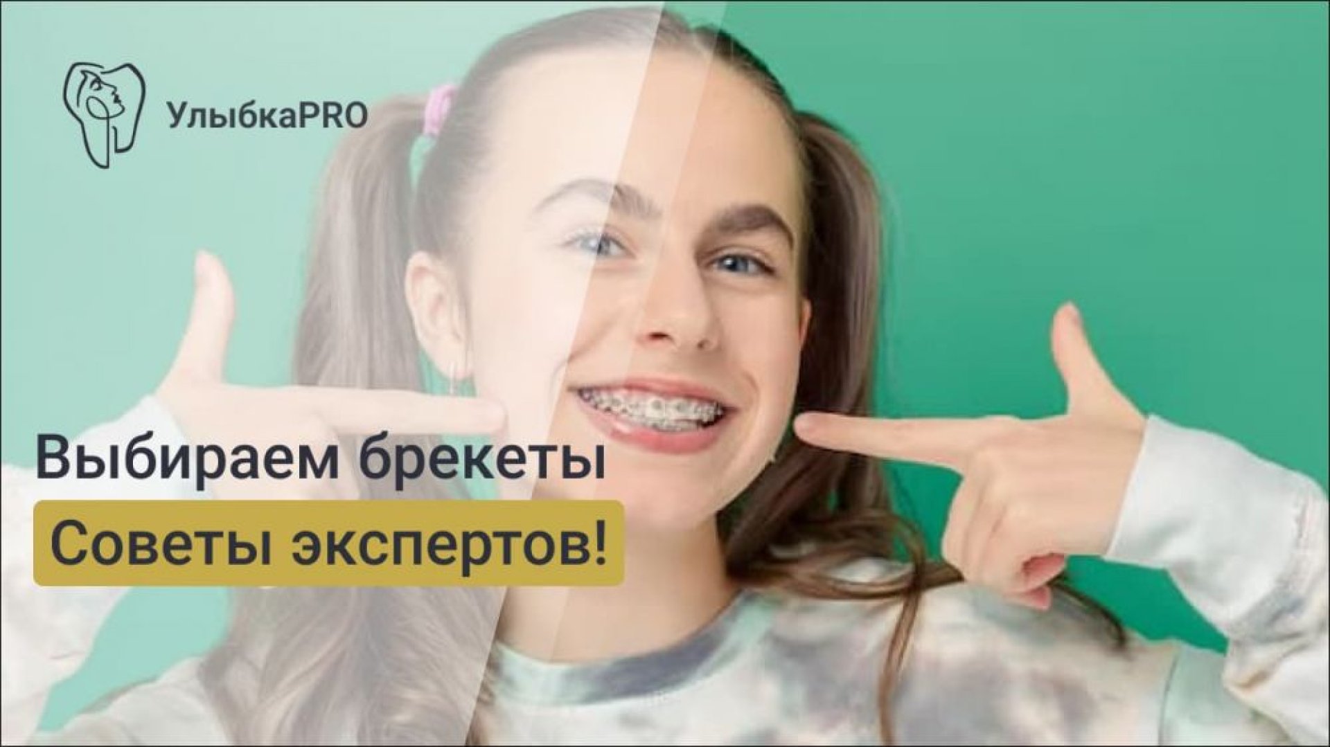 Как выбрать брекет-систему для исправления прикуса