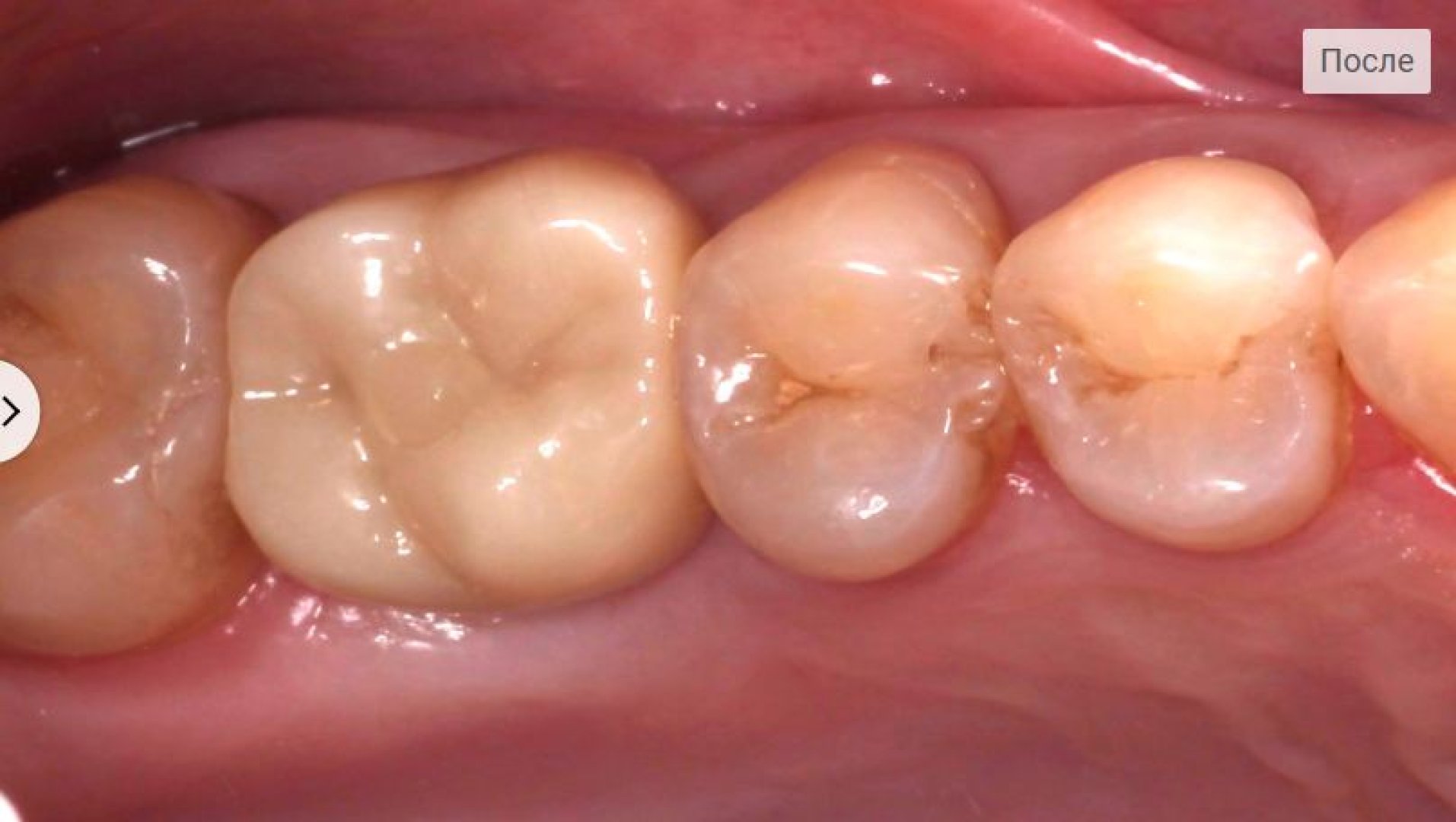 После лечения