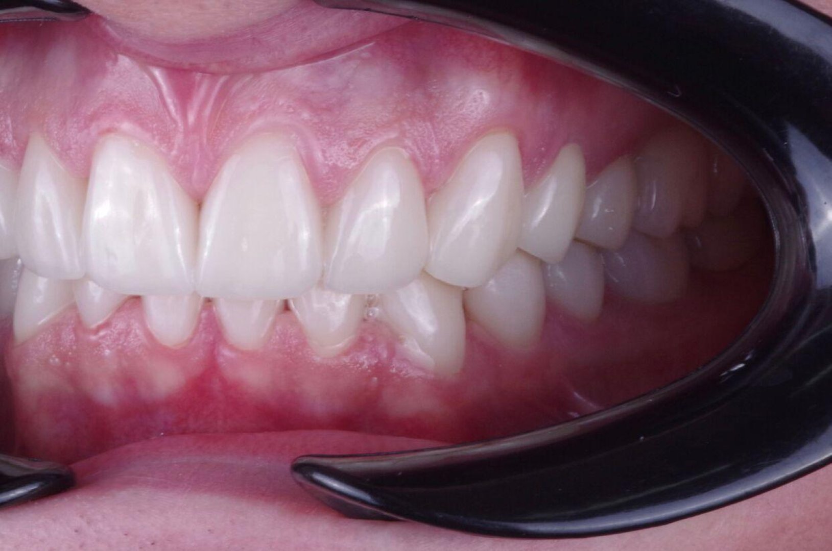 Виниры E.max — после лечения