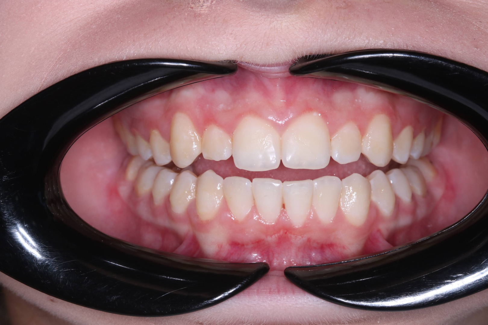 Исправление прикуса с помощью брекетов H4: выравнивание зубов