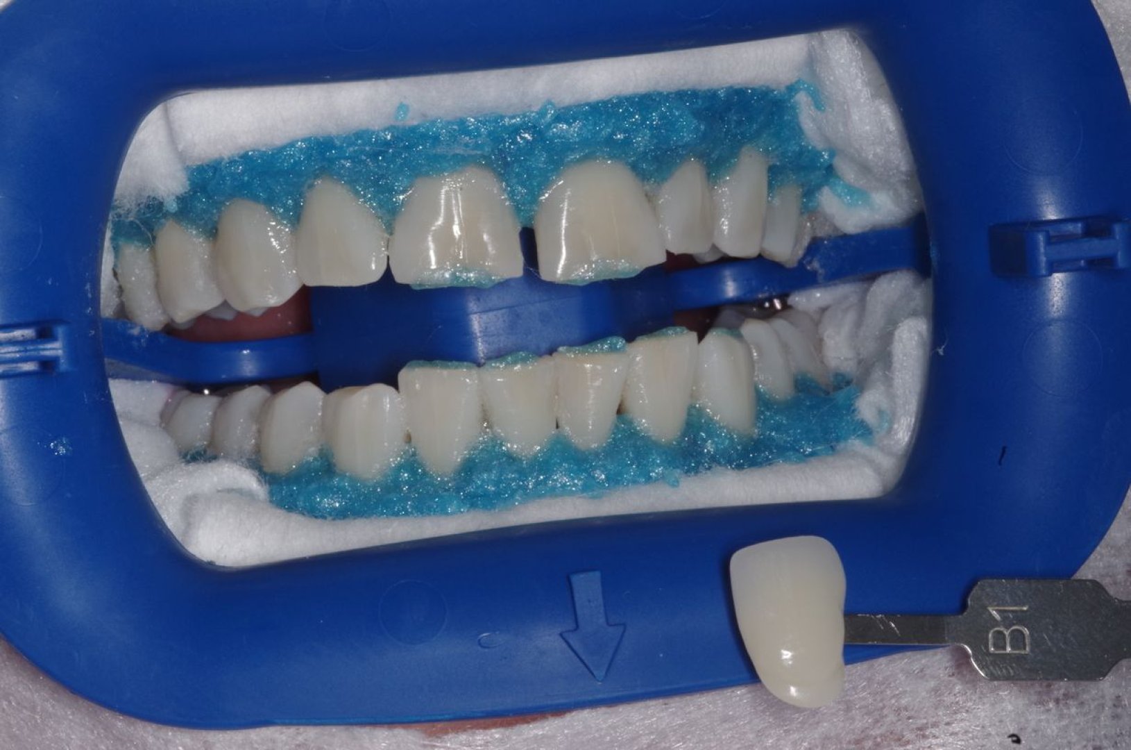 Отбеливание Zoom 4 и реставрация передних зубов