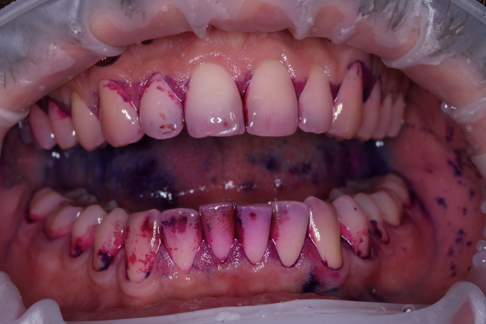 udalenie-naleta-ot-kureniya-gbt-do