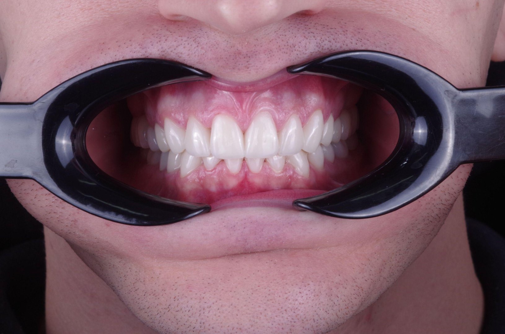 Результат виниров - деталь 2