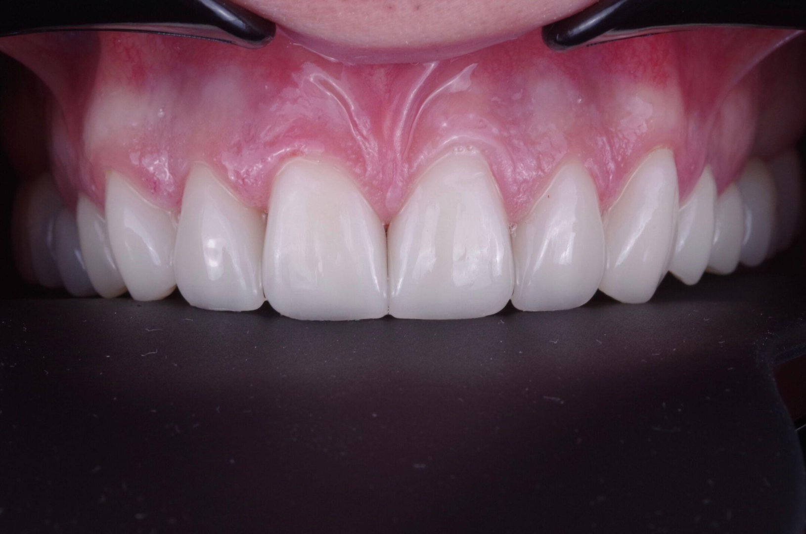 Результат виниров - деталь 3