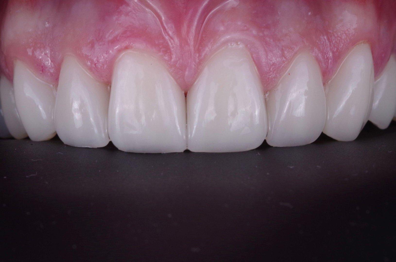 Результат виниров - деталь 4