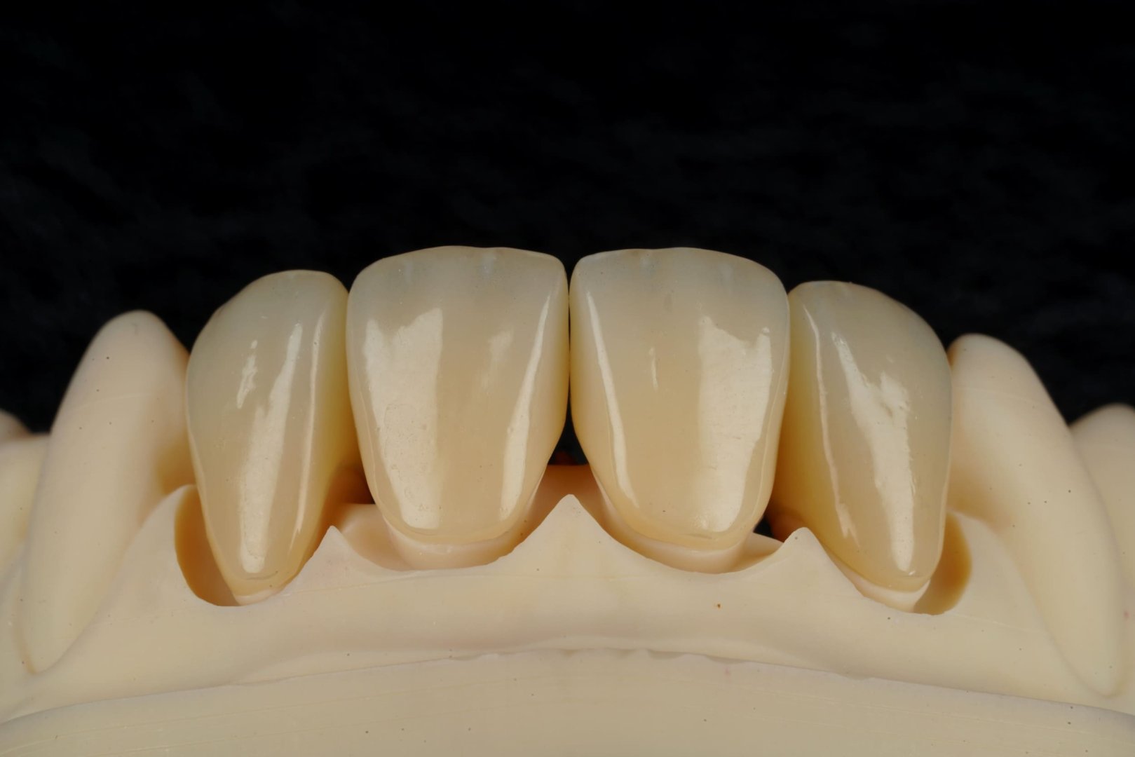 Циркониевая коронка — вид 2