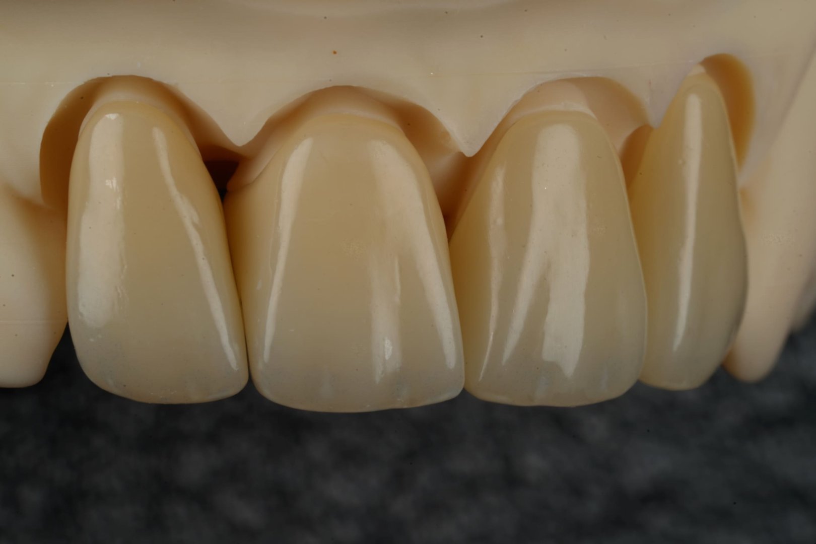 Циркониевая коронка — вид 3