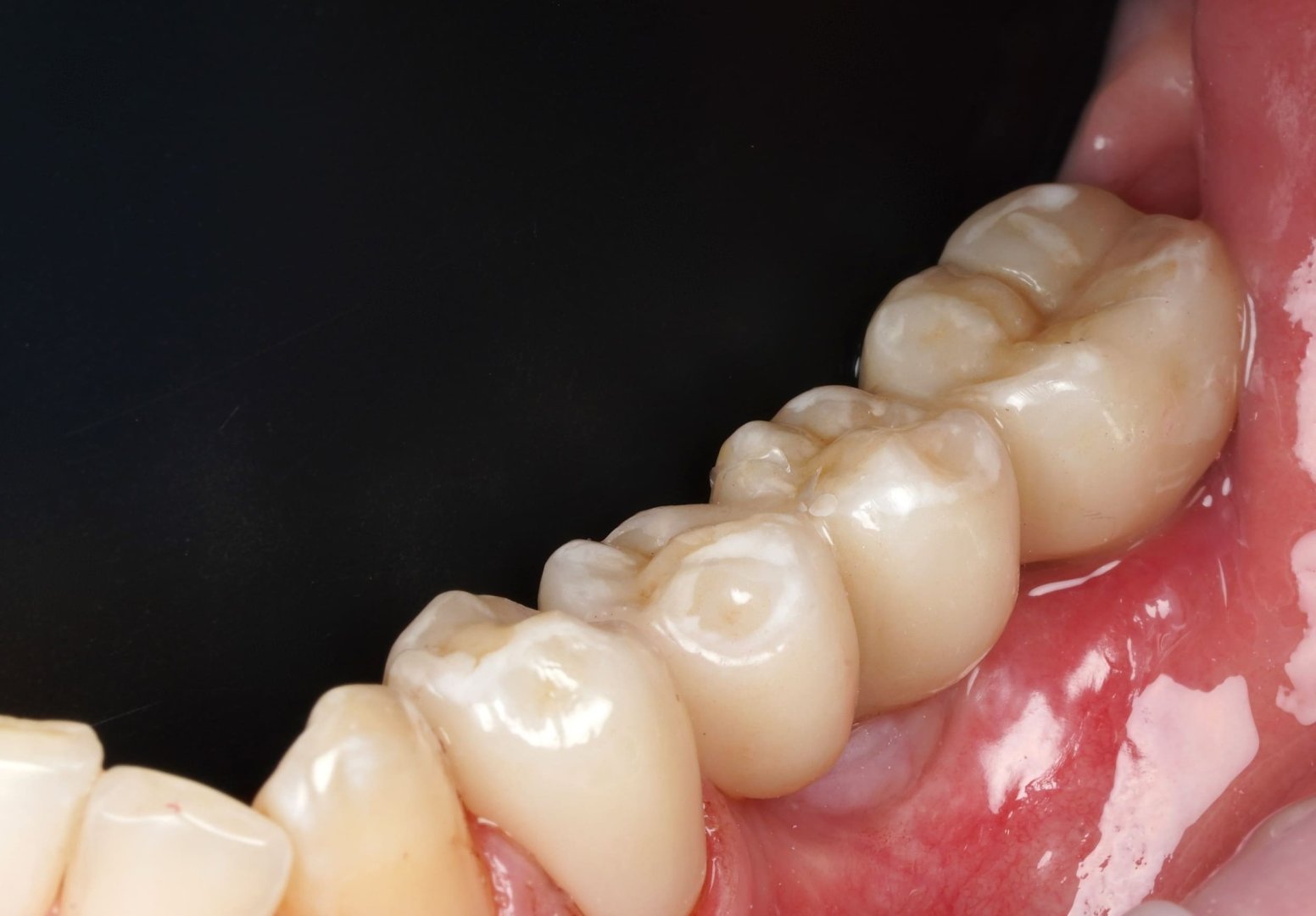 Циркониевая коронка — вид 4