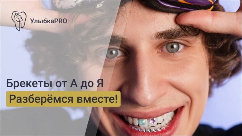 Виды брекетов: полный гид