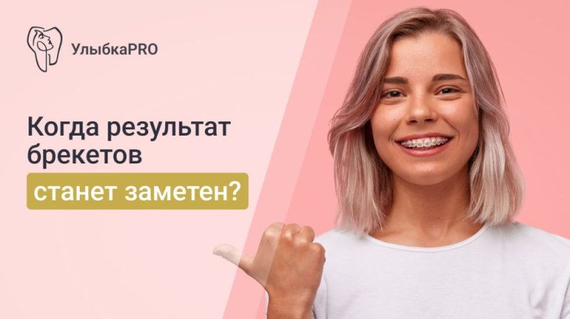Срок ношения брекетов
