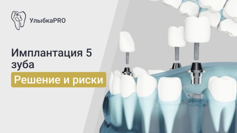 Имплантация 5 зуба