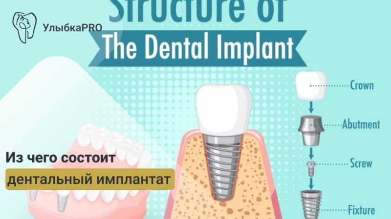 Из чего состоит дентальный имплантат: обзор материалов и технологий