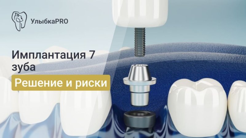 Имплантация 7 зуба