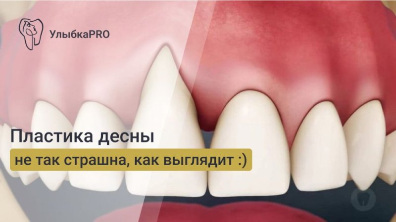 Пластика десны: что это такое и зачем её делать?