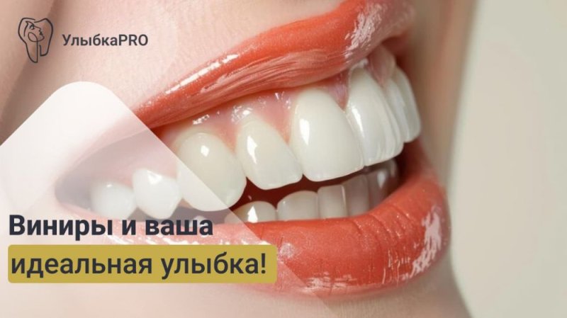 Процесс установки виниров: от консультации до идеальной улыбки