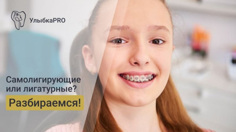 Самолигирующие и лигатурные брекеты: что выбрать?