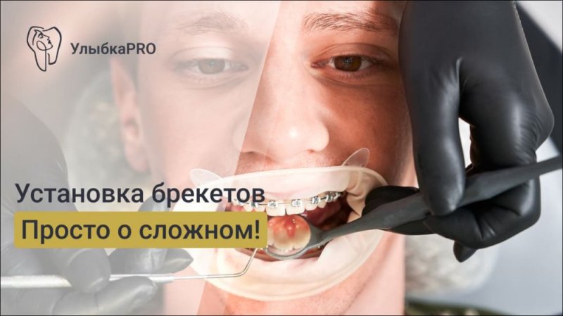 Установка брекетов: этапы процедуры
