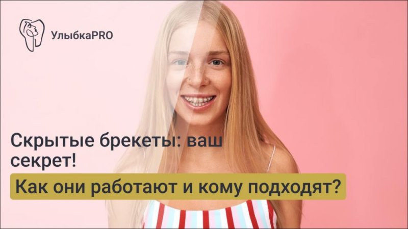 Скрытые брекеты: как они работают и для кого они подходят?