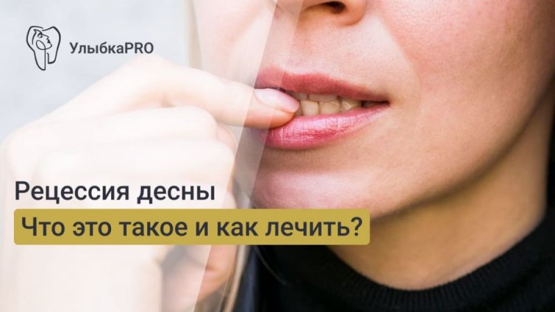 Что такое рецессия десны. Простое объяснение