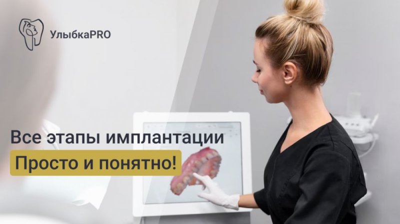 Этапы имплантации зубов: пошаговое руководство для пациентов