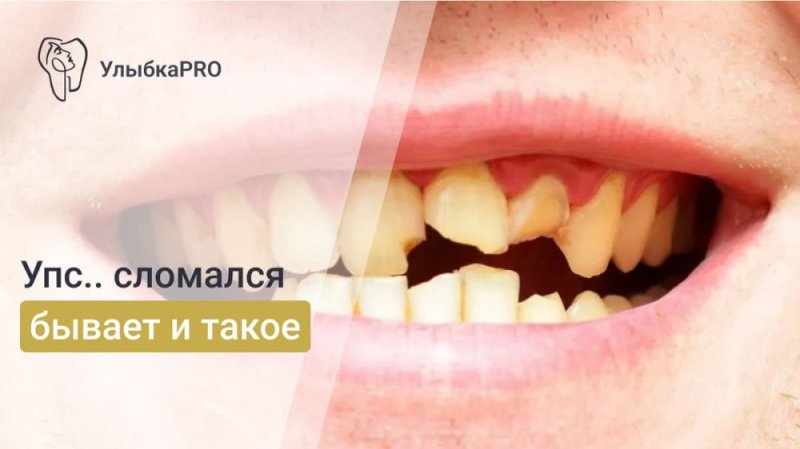 Что делать, если зуб сломался на мягкой пище? Экстренные меры и варианты восстановления