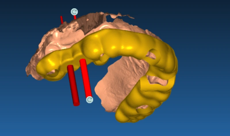 После: Хирургический 3D-шаблон для имплантации: планирование установки имплантов