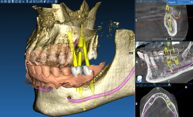 До: Хирургический 3D-шаблон для имплантации: планирование установки имплантов