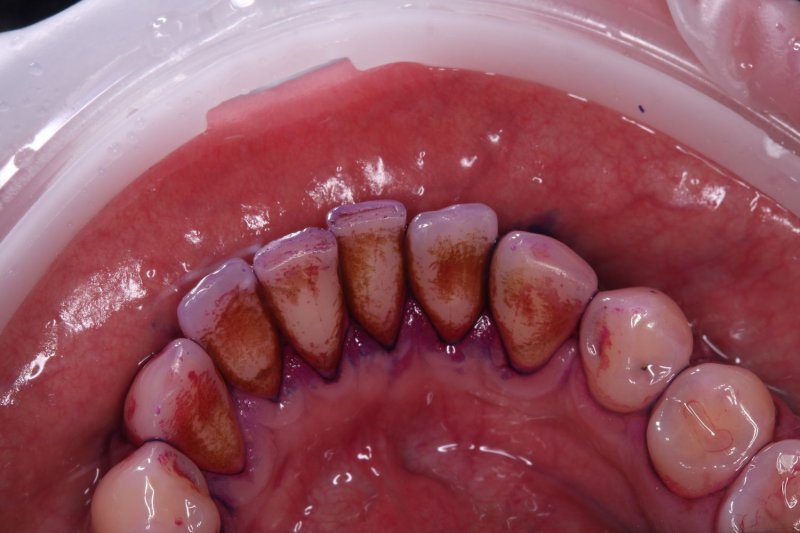 udalenie-naleta-ot-kureniya-gbt-rabota-1