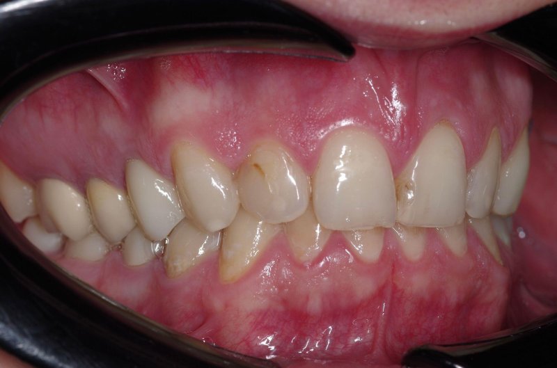 keramicheskie-viniri-foto-do-posle-2