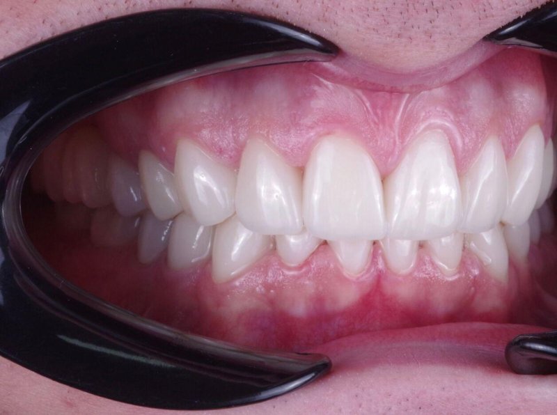 keramicheskie-viniri-foto-do-posle-6