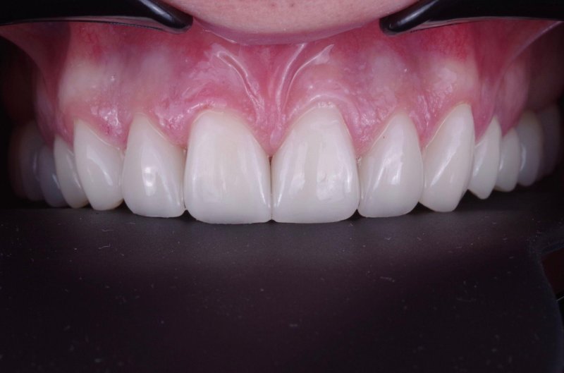 keramicheskie-viniri-foto-do-posle-9