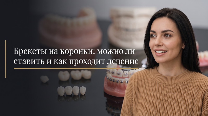 Брекеты на коронки: можно ли ставить и как проходит лечение