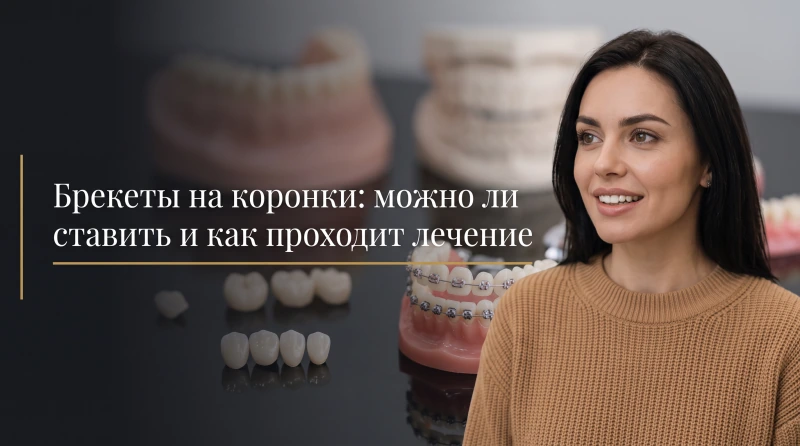 Брекеты на коронки: можно ли ставить и как проходит лечение