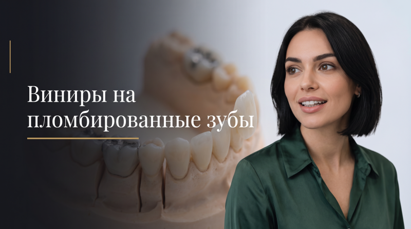 Виниры на пломбированные зубы