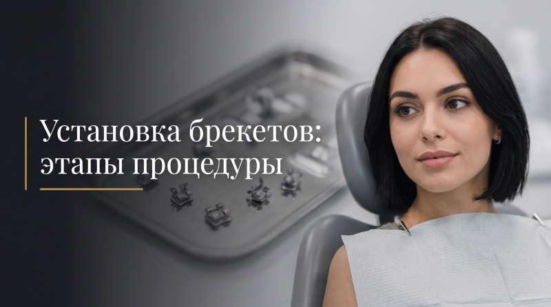 Установка брекетов: этапы процедуры