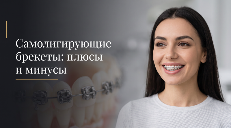 Самолигирующие брекеты: плюсы и минусы
