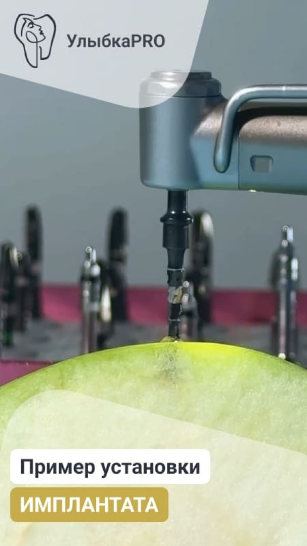 Наглядный пример установки ИМПЛАНТАТА | Стоматология УлыбкаPRO