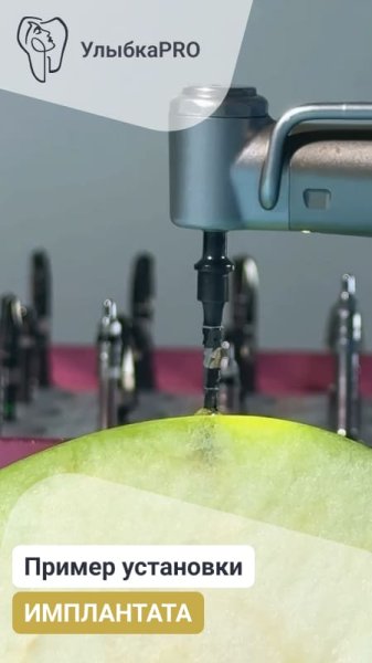 Наглядный пример установки ИМПЛАНТАТА | Стоматология УлыбкаPRO