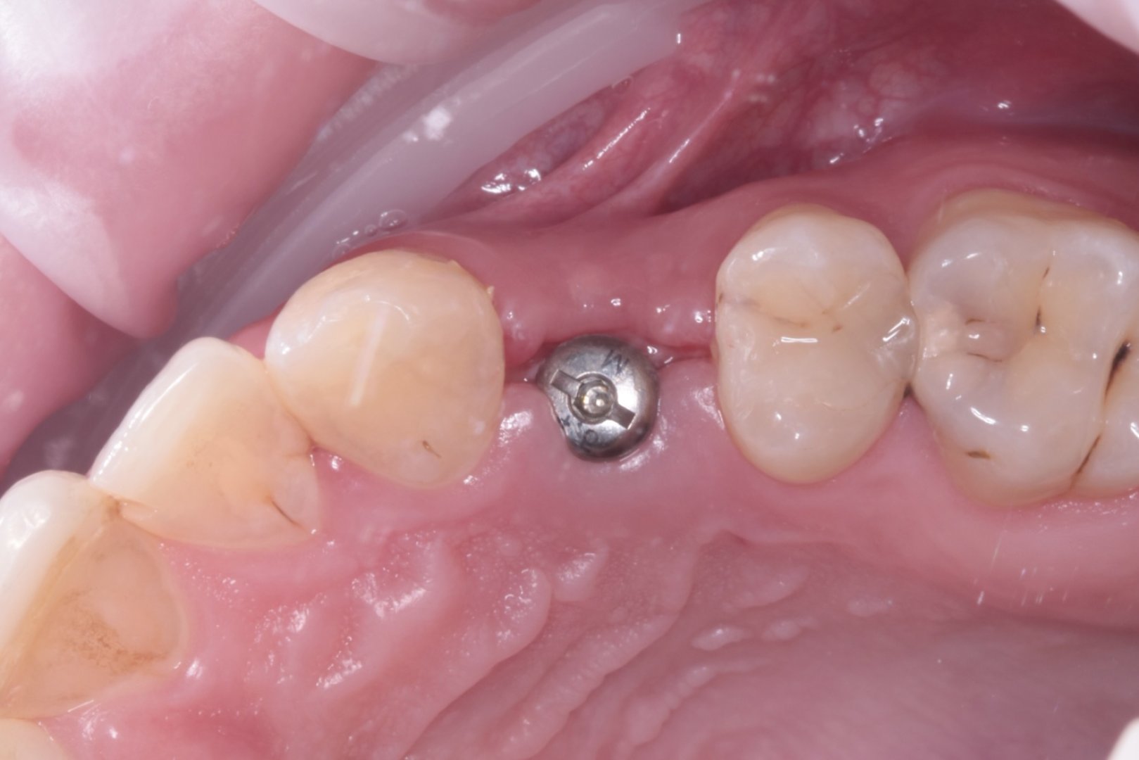 Коронка из диоксида циркония на имплантате_before