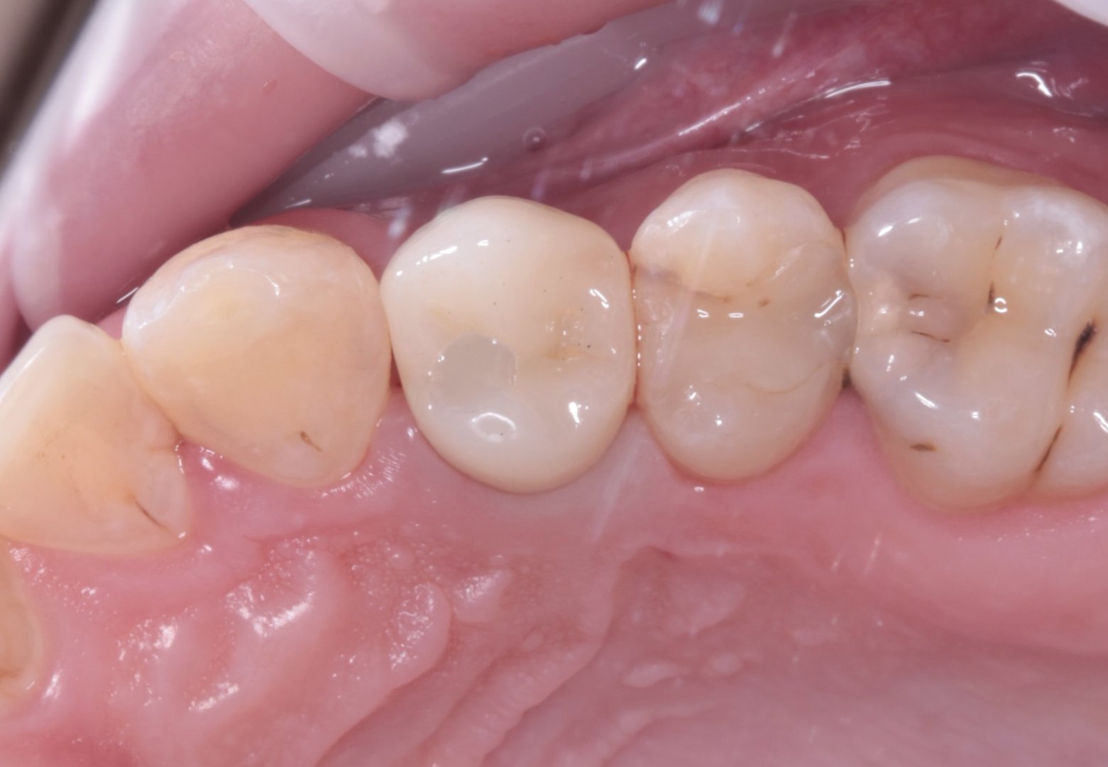 Коронка из диоксида циркония на имплантате