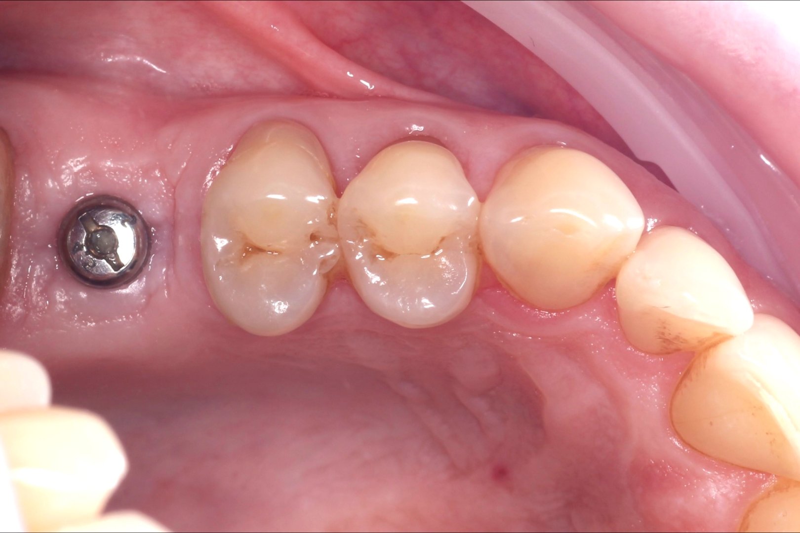 Циркониевая коронка на имплантате_before