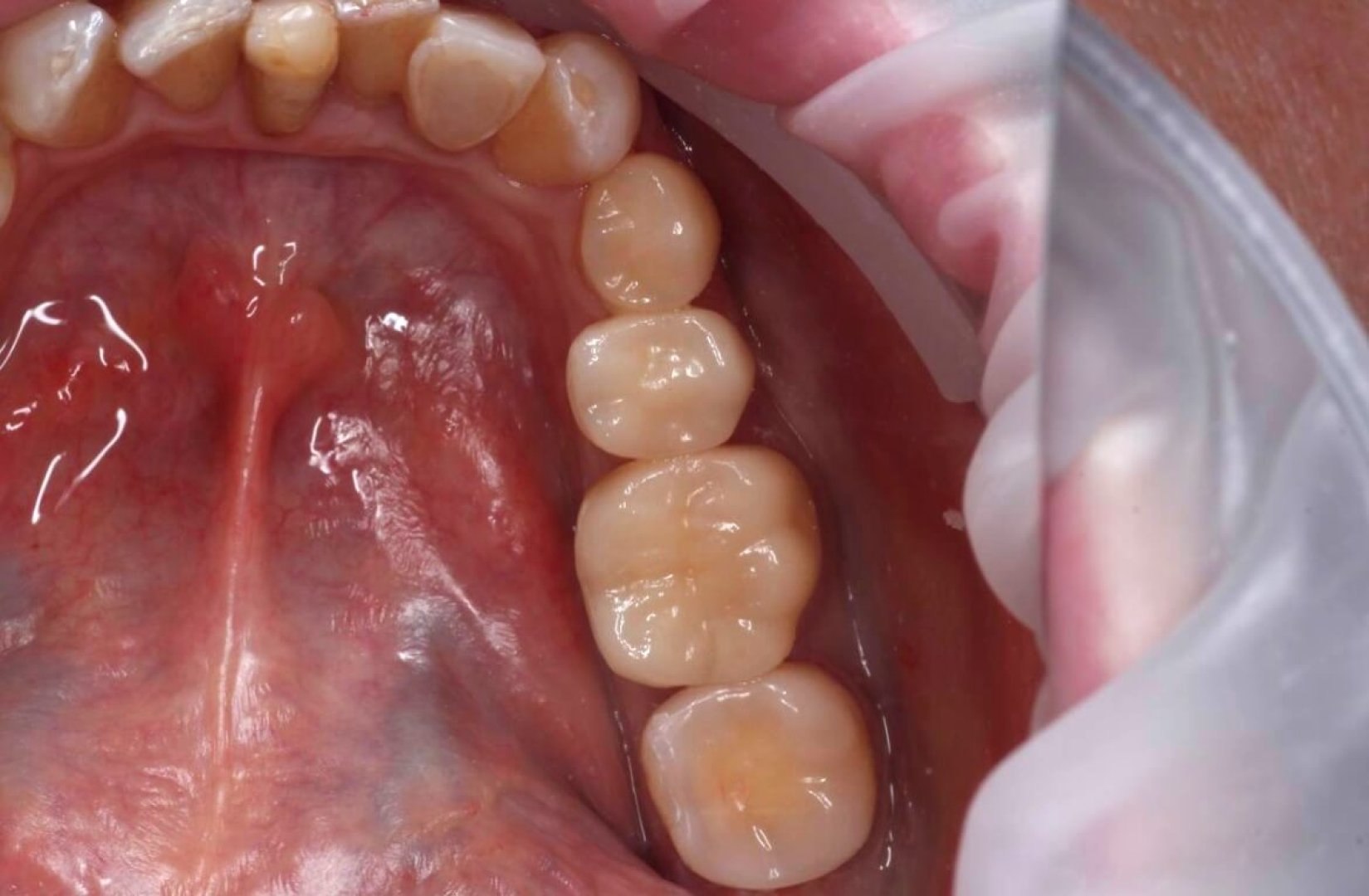 Восстановление зубов циркониевыми коронками_after