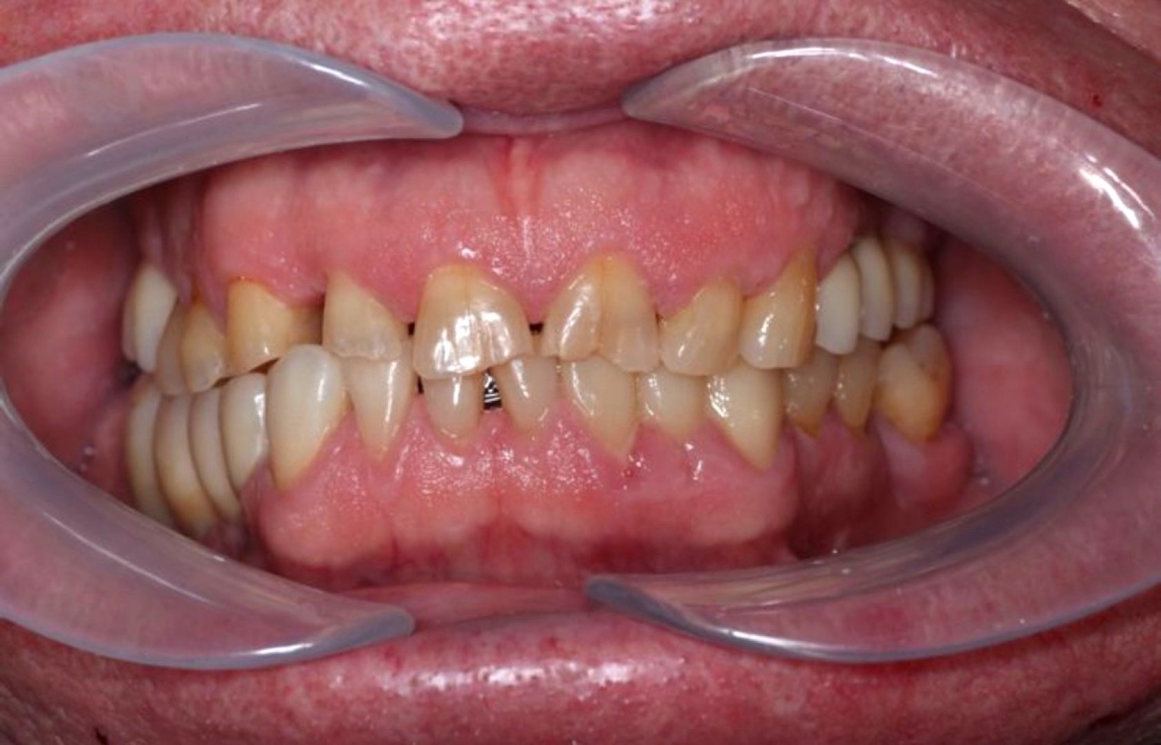 Новая улыбка за несколько дней!_before