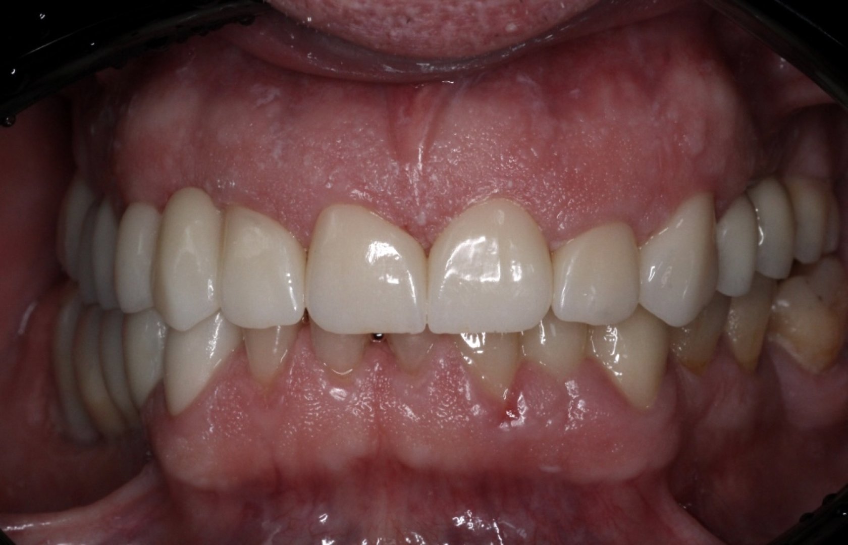 Новая улыбка за несколько дней!